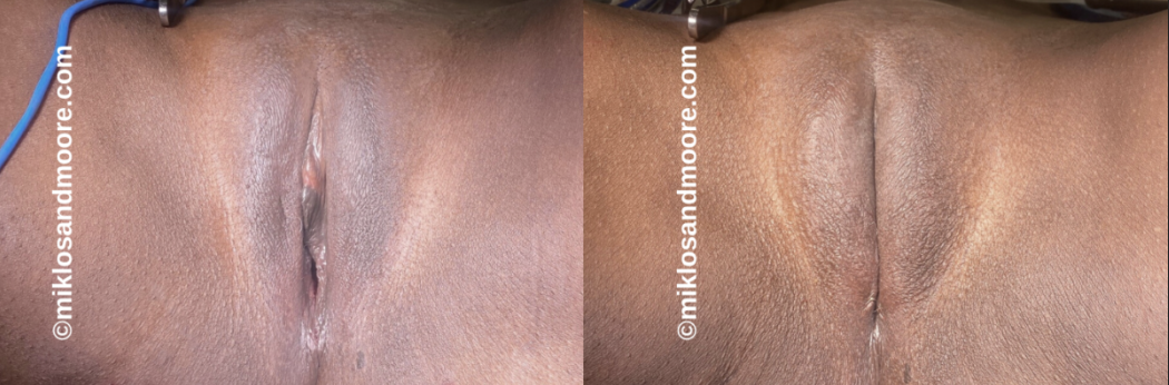 Healed labia majora augmentation before and after photos showing the final cosmetic results after complete recovery.
