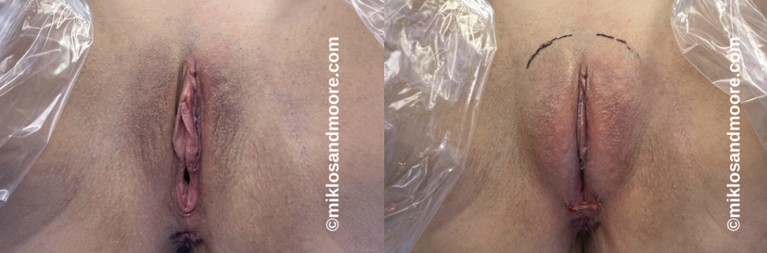 Labia majora augmentation recovery before and after photos showing the healing process and restored volume following fat transfer or filler treatment.