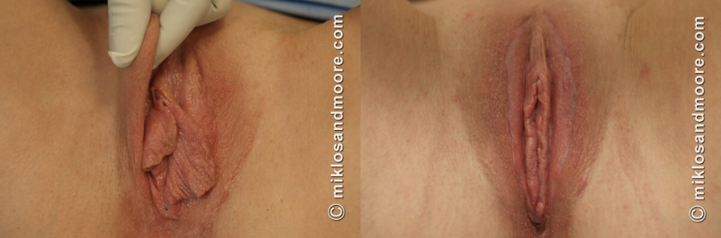 Healed labia majora reduction before and after photos showing the final cosmetic results after complete recovery.