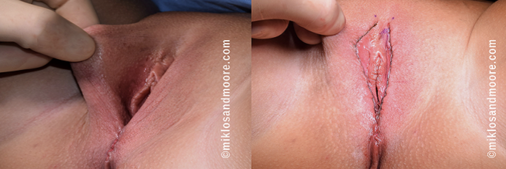 Labia majora reduction recovery before and after photos showing the healing process and improved contour following cosmetic surgery.