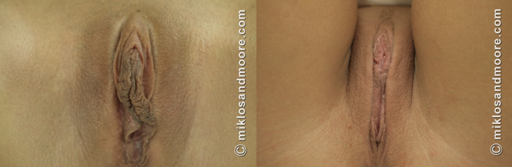 Healed labia minora reduction before and after photos showing final surgical results by Dr. Miklos and Dr. Moore.