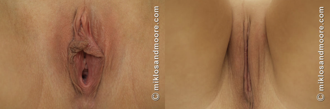 Labiaplasty recovery before and after photos showing healed results following labiaplasty surgery by Dr. Miklos and Dr. Moore.