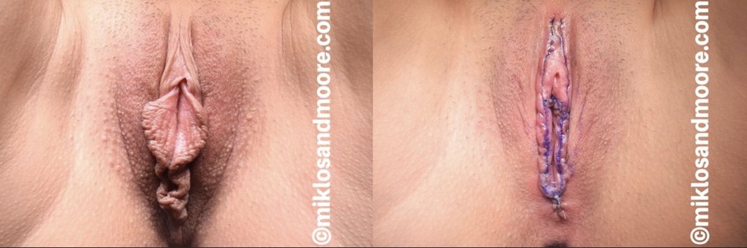 Labiaplasty before and immediate after surgery photos showing the initial surgical result by Dr. Miklos and Dr. Moore.
