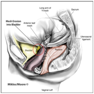 Medical illustration showing vaginal mesh erosion into the bladder after pelvic prolapse surgery