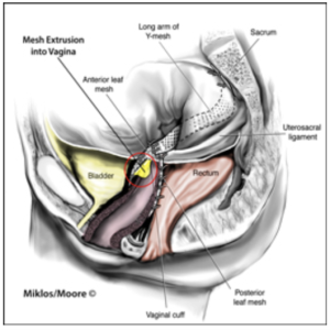 Medical illustration showing vaginal mesh extrusion into the vagina after pelvic prolapse surgery