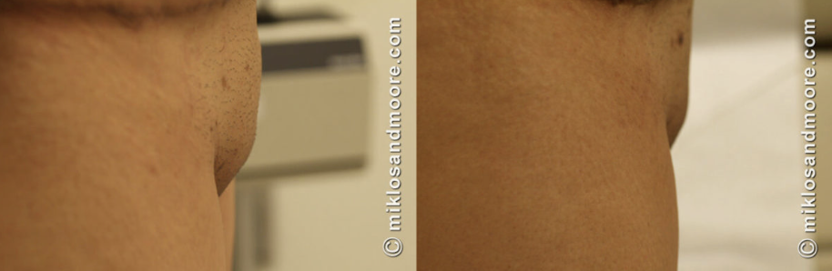 Monsplasty recovery before and after photos showing the healing process and improvement in the contour of the mons pubis following cosmetic monsplasty surgery.