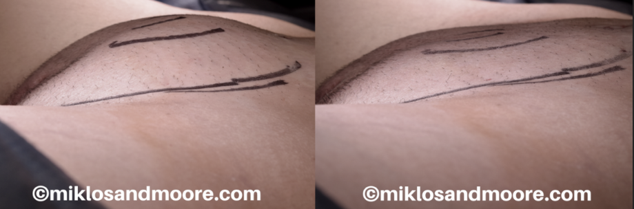 Healed monsplasty before and after photos showing the final results after complete recovery from mons pubis reduction surgery.