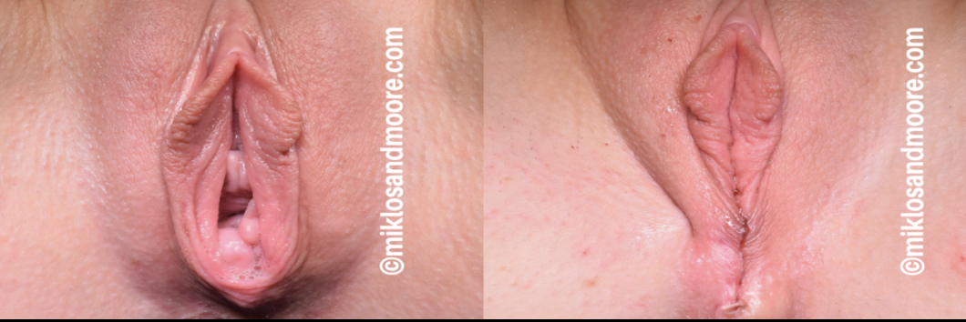Perineoplasty before and after photos showing repair of the perineum after childbirth by Dr. Miklos and Dr. Moore.
