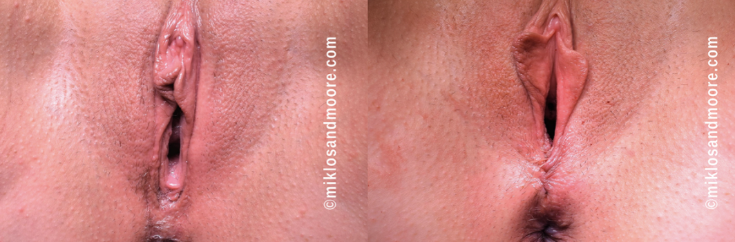 Before and after perineoplasty surgery to repair the perineum and restore vaginal support performed by Dr. Miklos and Dr. Moore.