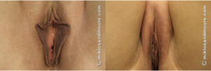 Before and after vaginal rejuvenation surgery showing reconstructive results by Miklos and Moore