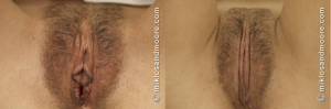 Before and after vaginal rejuvenation surgery showing reconstructive results by Miklos and Moore