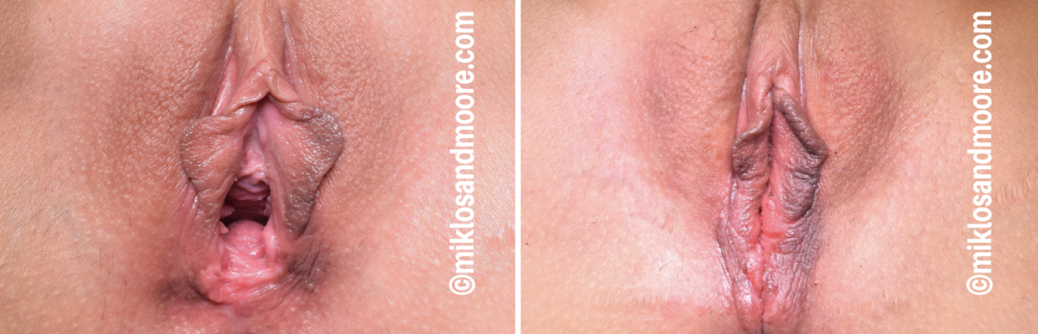 Vaginoplasty recovery before and after photos showing the healing process and restoration of the vaginal opening following cosmetic vaginoplasty surgery.