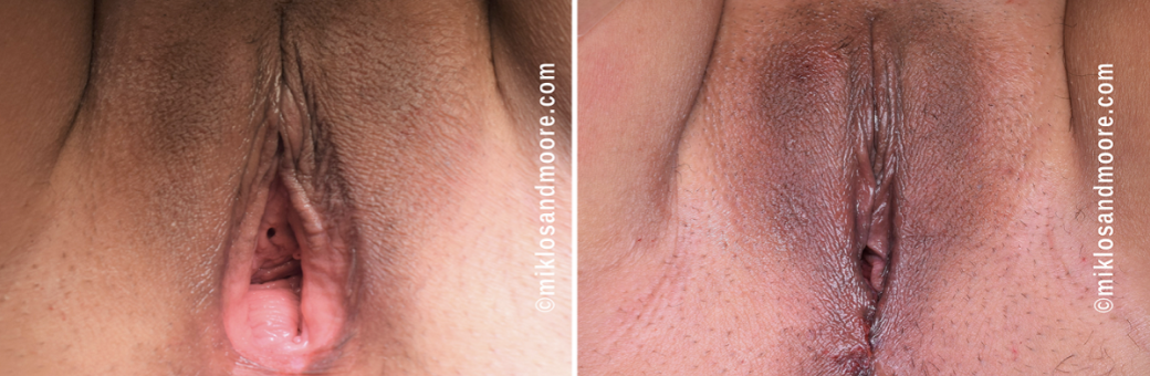 Healed vaginoplasty before and after photos showing the final cosmetic and functional results after complete recovery from vaginal tightening surgery.