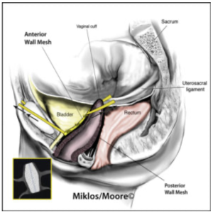 Anterior and posterior vaginal wall mesh placement for pelvic organ prolapse
