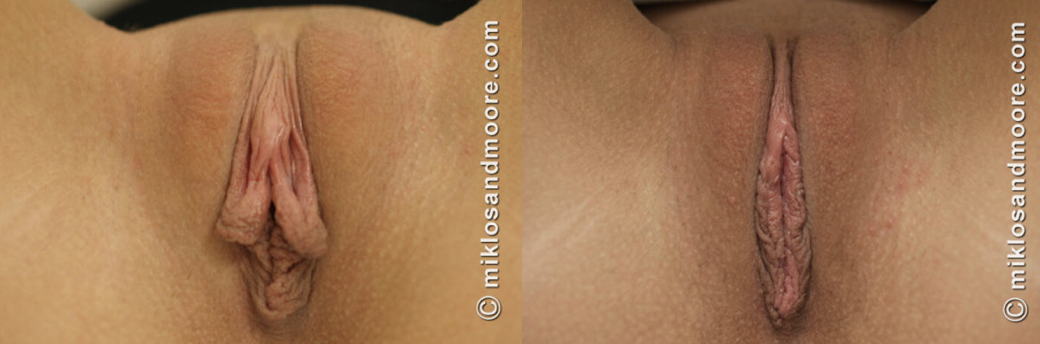 Healed clitoral hood reduction before and after photos showing final surgical results by Dr. Miklos and Dr. Moore.