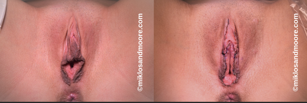 Clitoral hood reduction before and immediate after surgery photos showing the initial surgical result by Dr. Miklos and Dr. Moore.