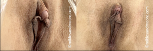 Clitoropexy before and after for clitoral enlargement associated with testosterone