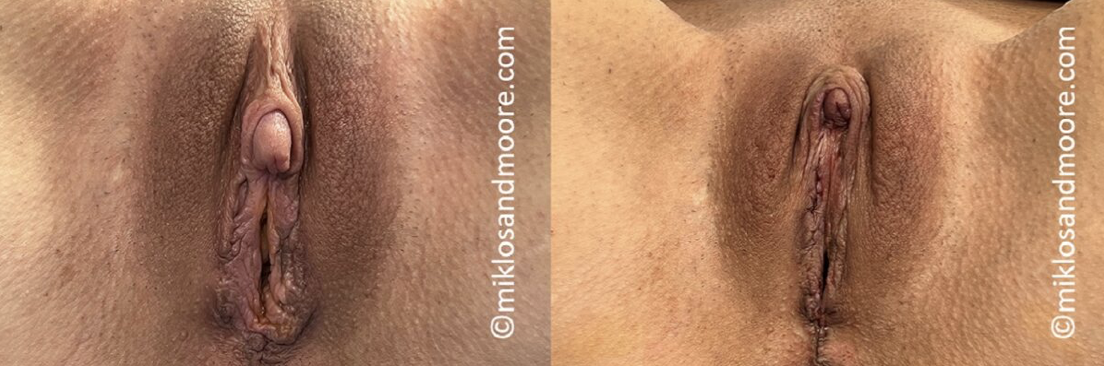 Clitoropexy recovery before and after showing healed results following clitoral repositioning surgery by Dr. Miklos and Dr. Moore.