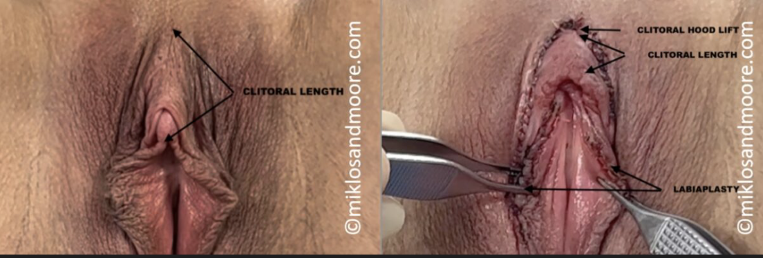 Before and after clitoropexy recovery photos showing healed surgical results after clitoral repositioning by Dr. Miklos and Dr. Moore.