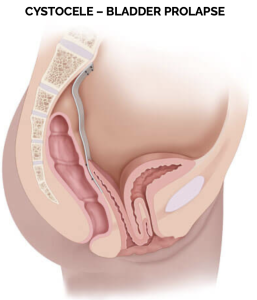 Cystocele bladder prolapse showing weakened support of the bladder and anterior vaginal wall