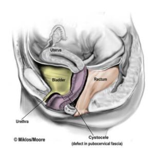 Cystocele bladder prolapse medical illustration showing pelvic organ prolapse