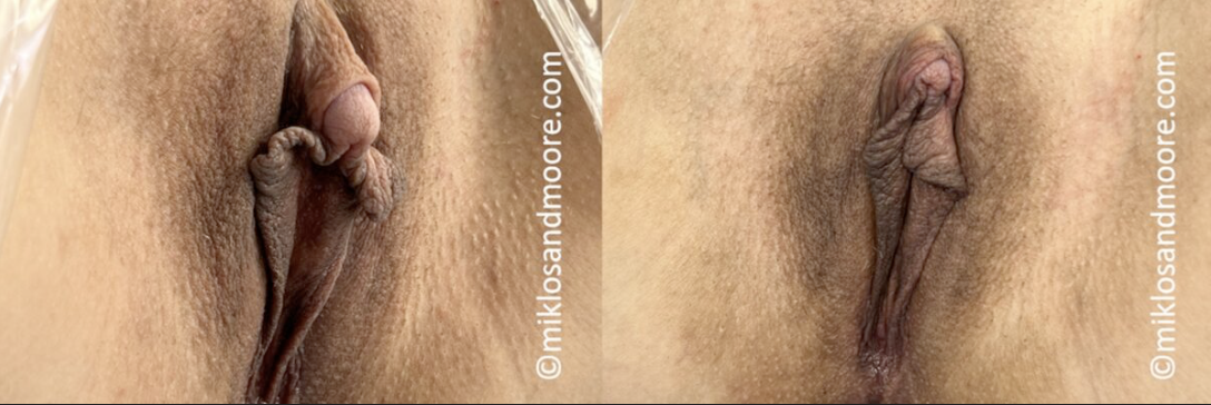 Before and after clitoral reduction showing treatment of an enlarged protruding clitoris