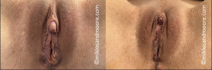 Before and after clitoropexy showing treatment of an enlarged clitoris associated with testosterone