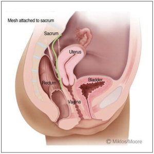 Hysteropexy illustration showing uterus-preserving prolapse repair with suspension to the sacrum
