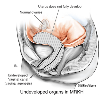 MRKH syndrome anatomy showing underdeveloped uterus and vaginal agenesis with normal ovaries