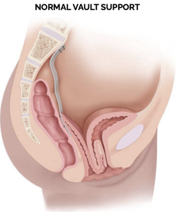 Normal bladder and vaginal support compared with cystocele bladder prolapse