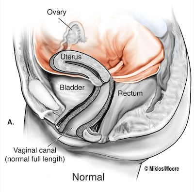 Normal female pelvic anatomy showing uterus ovaries and full-length vaginal canal
