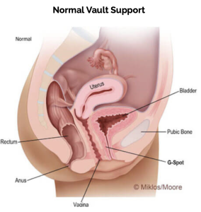 Normal vaginal vault and pelvic organ support compared with recurrent prolapse