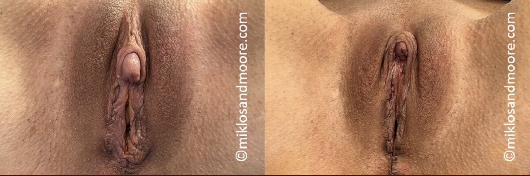 Before and after surgery for a prominent enlarged clitoris showing postoperative improvement