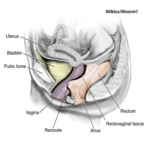 Rectocele illustration showing the rectum bulging through weakened rectovaginal fascia