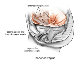 Medical illustration showing a shortened vagina with vaginal vault scarring and loss of vaginal length