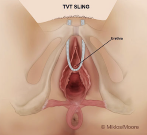 TVT bladder sling showing retropubic mesh placement beneath the urethra