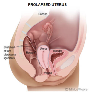 Uterine prolapse illustration showing pelvic anatomy and weakened uterosacral ligaments