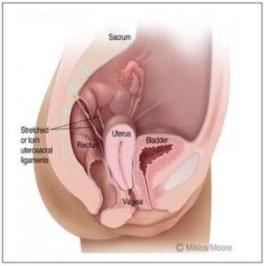 Uterine prolapse caused by weakened uterosacral ligaments before prolapse surgery