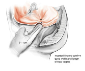 Medical illustration showing restored vaginal depth of approximately 9 to 11 cm after vaginal reconstruction