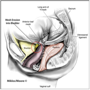 Vaginal mesh erosion into the bladder following pelvic organ prolapse surgery