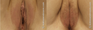 Vaginal rejuvenation before and after surgery by Miklos and Moore in Atlanta Georgia