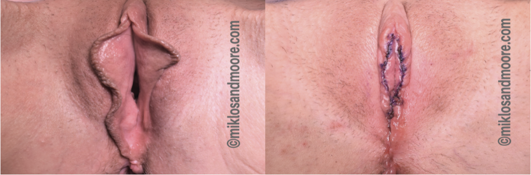Before and after vaginal rejuvenation surgery showing changes following vaginal and perineal repair
