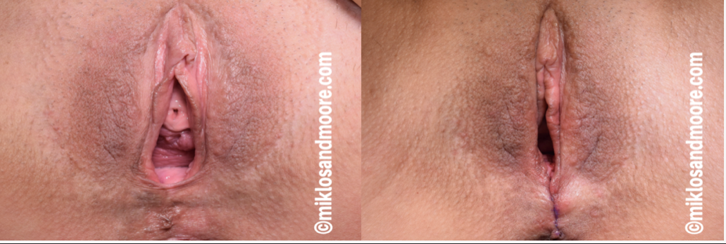 Vaginal rejuvenation before and after photos showing surgical repair and reconstruction of the vaginal opening