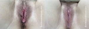 Before and after vaginal rejuvenation surgery showing postoperative vulvar and vaginal results