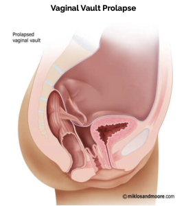 Vaginal vault prolapse after previous pelvic organ prolapse surger