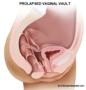 Vaginal vault prolapse medical illustration showing prolapse after hysterectomy